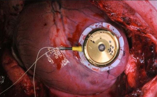 Good News: बैटरी के बिना चलता है यह पेसमेकर, दिल की धड़कनों से होता है चार्ज
