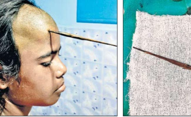 रांची : 14 साल की बच्ची के सिर में फंसा था तीर, ऑपरेशन कर निकाला
