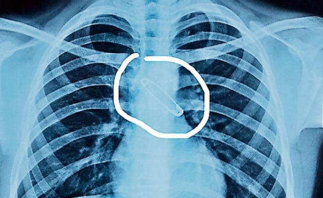 रांची : मुंह में सेफ्टी पिन दबाकर कार्टून देख रहा था बच्चा, खांसी आयी और सांस की नली में जा फंसा