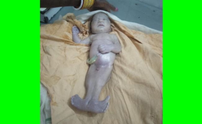 सोशल मीडिया में Viral हुआ गोला में जन्मा अजीब बच्चा, अस्पताल में उमड़ी लोगों की भीड़