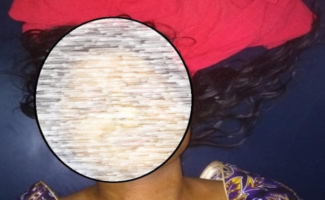 पति ने अपनी ही पत्नी के चेहरे पर डाला तेजाब, दो लाख रुपये की कर रहा था मांग