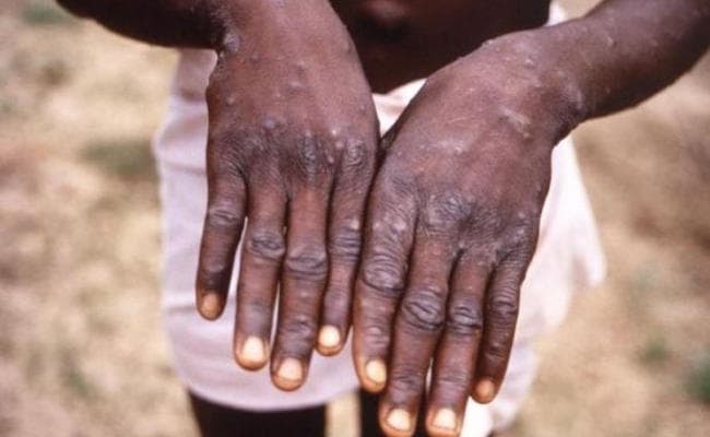 सिंगापुर में दुर्लभ वायरस मंकीपॉक्स का पहला मामला सामने आया