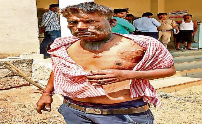 पिता ने दो बच्चों को जिंदा जलाया,  एक की मौत