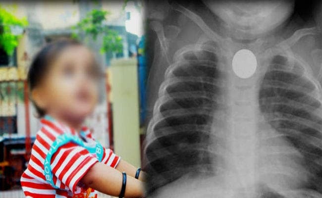 मासूम के गले में अटका था सिक्का, इलाज को बिलखता रहा परिवार