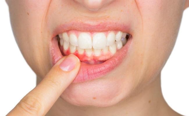 दांतों के खराब होने और मसूड़ों की बीमारी के लिए आपका ''जीन'' हो सकता है जिम्मेदार