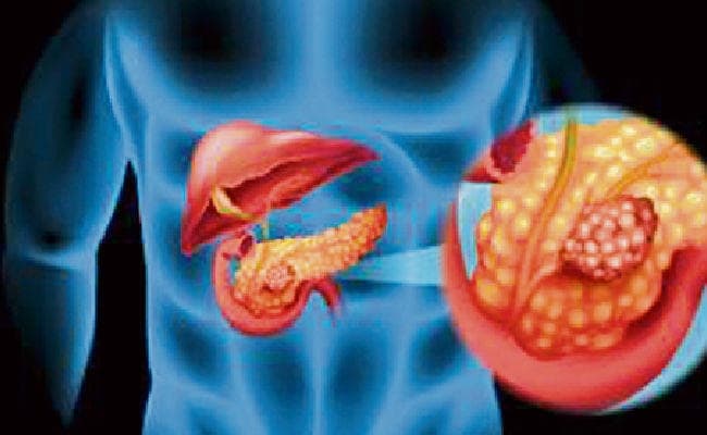 ब्लड शुगर के कारण हो सकता है पैंक्रियाटिक कैंसर का खतरा