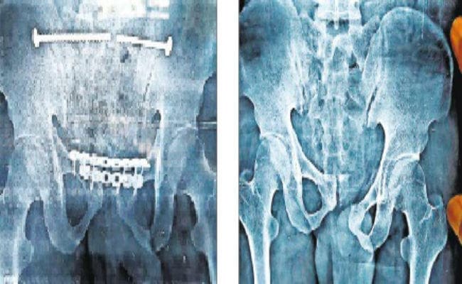 सड़क हादसे में घायल युवक का हुआ जटिल ऑपरेशन, मिला नया जीवन