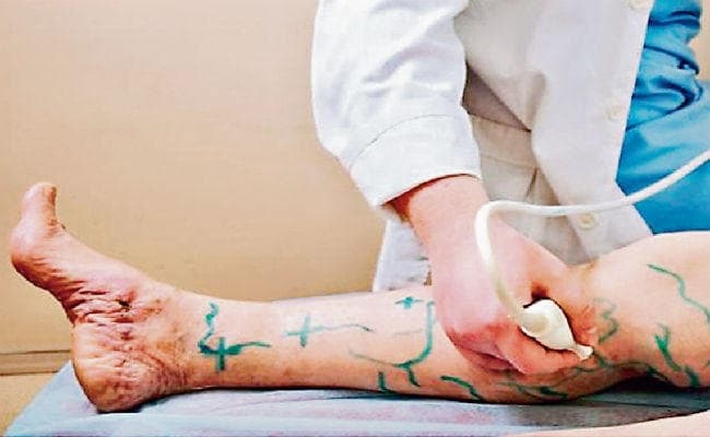 वैरिकोज वेंस को न करें नजरअंदाज