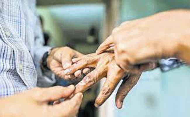 कुष्ठ रोगियों की खोज को 19 से विशेष अभियान