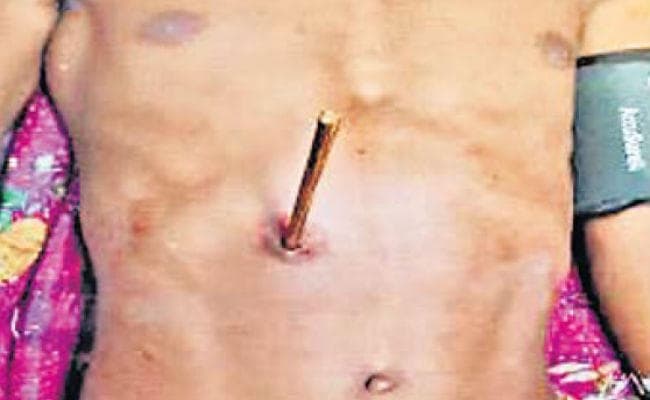 रांची : सांस की नली से बैटरी व पेट में घुसा तीर निकाला