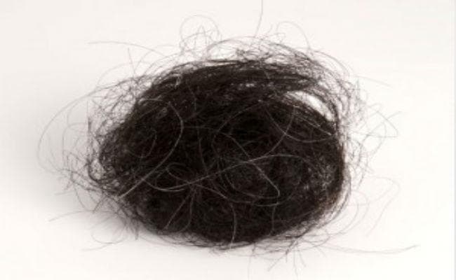 आईजीआईएमएस में किशोर की हुई सर्जरी में उसके पेट निकाले गये सिस्ट से दांत और बाल के गुच्छे निकले