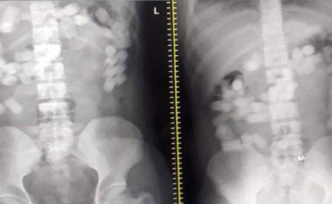 OMG! 10 दर्जन केले खिलाकर 7 लोगों के पेट से निकाली ड्रग्स की 177 गोलियां