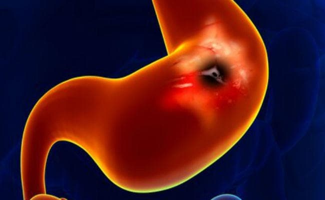 आंत में जलन, हो सकता है पेप्टिक अल्सर, जानें लक्षण और उपाय