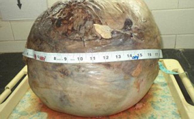 OMG! डॉक्टरों ने महिला की बच्चेदानी से निकाला फुटबॉल जितना बड़ा 18 किलो का ट्यूमर