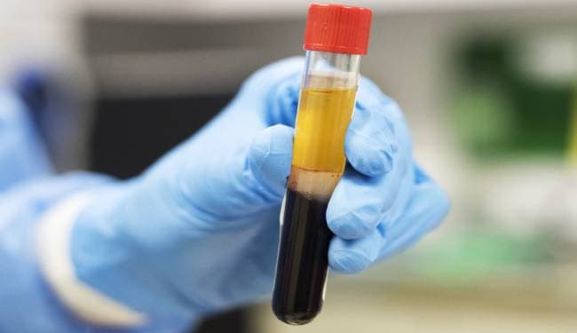 प्रदेश में प्लाज्मा थेरेपी को बढ़ाने पर विचार हो : योगी