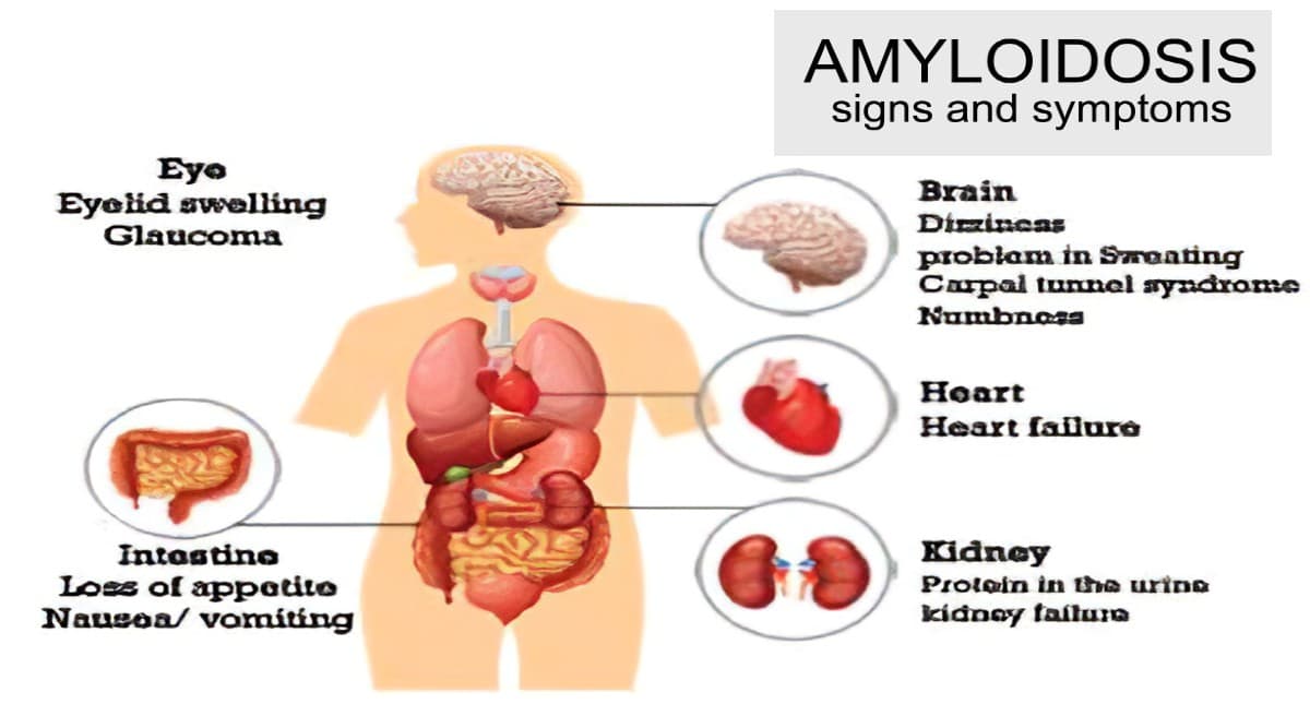 Amyloidosis से जूझ रहे हैं पाकिस्तान के पूर्व राष्ट्रपति जनरल परवेज मुशर्रफ, जानिए इसके बारे में