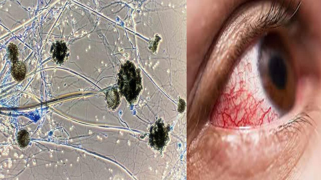 Black Fungus : झारखंड की राजधानी रांची में ब्लैक फंगस से दो मरीजों की मौत, अबतक 29 मरीजों की जा चुकी है जान