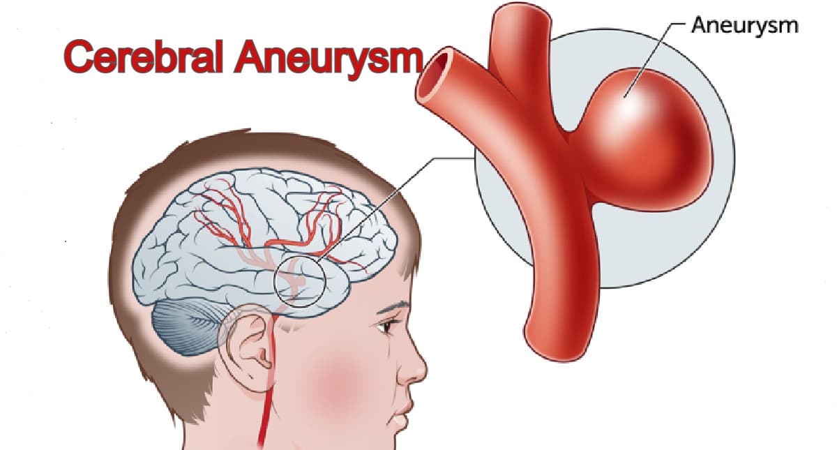 Cerebral Aneurysm से पीड़ित हैं चीनी राष्ट्रपति, जानें क्या है सेरेब्रल एन्यूरिज्म? लक्षण, बचाव क्या हैं?