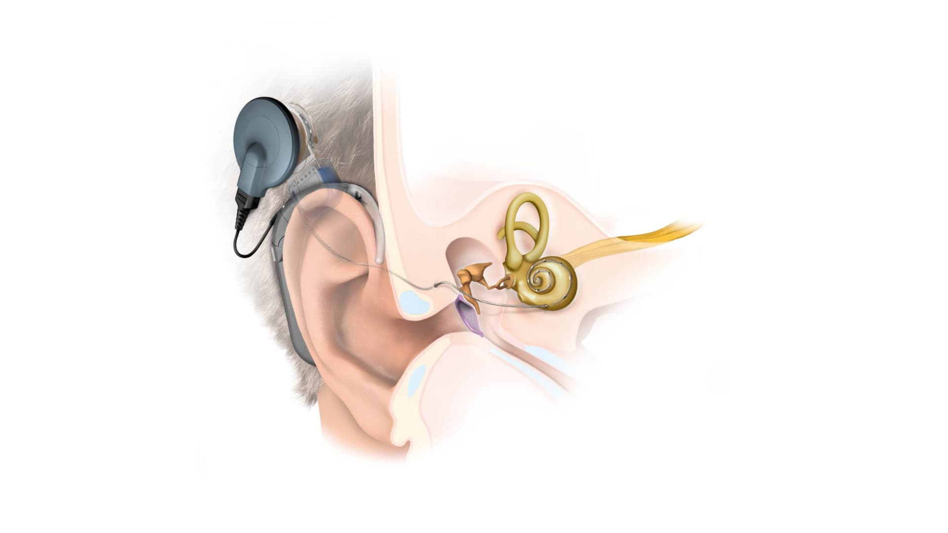 मजदूर की बेटी का मुफ्त में हुआ था Cochlear Implant, अब सुनने लगी, जानें पूरी कहानी