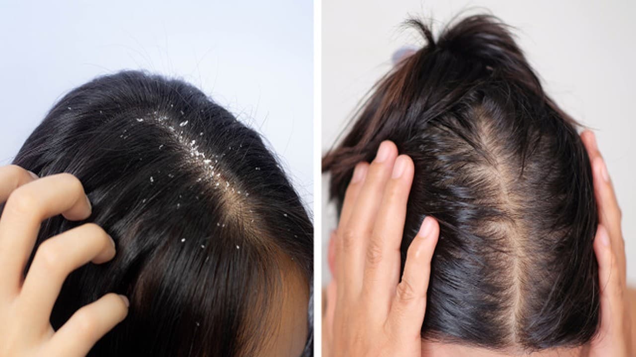 How To Get Rid of Dandruff: रूसी से कैसे छुटकारा पाएं, जानें घरेलू उपाय