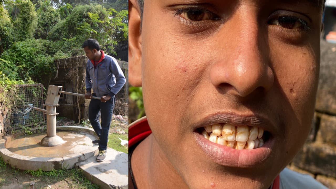 धनबाद के घड़बड़ की 80 फीसदी आबादी फ्लोराइड से प्रभावित, दामोदर के पानी की बगैर फिल्टर किये हो रही आपूर्ति