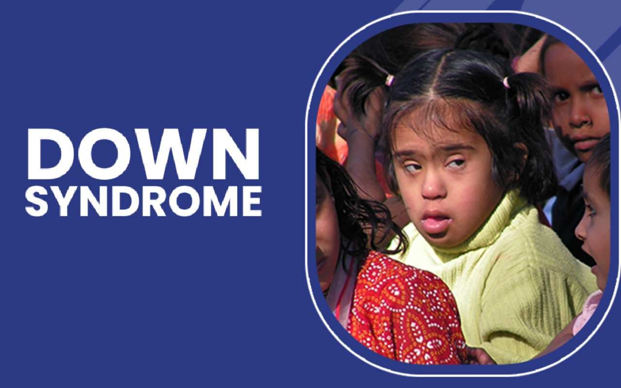 Down Syndrome में समय से पहले बुढ़ापे के लिए DNA की मरम्मत को बाधित करने वाला अतिसक्रिय जीन जिम्मेदार