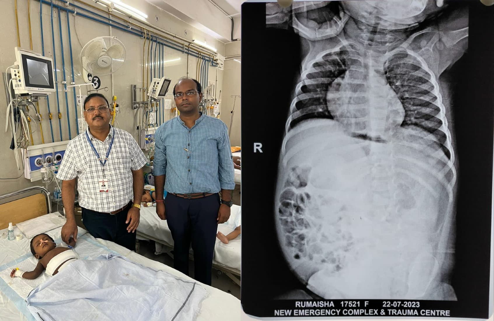 Medical Miracle: 13 महीने की बच्ची के पेट से निकाला गया दो किलो का भ्रूण, केजीएमयू के डॉक्टरों ने किया ऑपरेशन