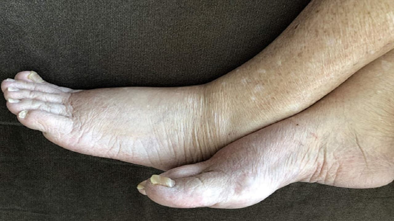 फाइलेरिया खत्म करने के लिए झारखंड में घर-घर जाकर दी जा रही हैं दवाएं, दवा खाने के बाद दिख सकते हैं ये इफेक्ट