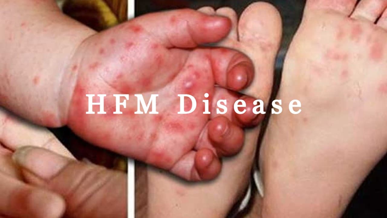 क्या है HFM? बच्चों में दिखाई दे ये लक्षण तो हो जाएं सावधान