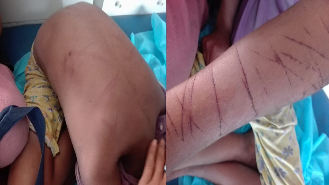 Bihar News: दो शिक्षकों ने आठवीं के छात्र को पीटा, बच्चे के शरीर पर स्टिक व थप्पड़ के कई निशान