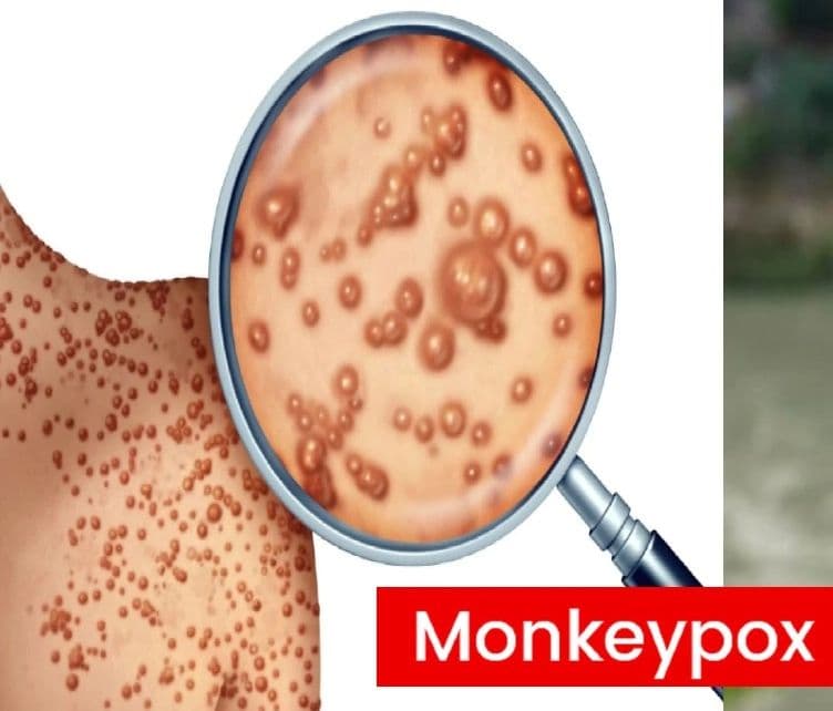 Monkey Pox: देश में पहला केस आया सामने, मंकीपॉक्स के मद्देनज़र दिशानिर्देश जारी, इन लोगों से बचें