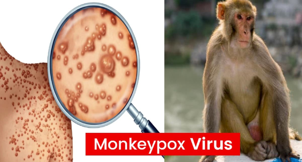 बिहार में भी अब खतरनाक वायरस Monkey Pox का खौफ, सरकार की बढ़ी चिंता, जानें क्यों जारी किया अलर्ट