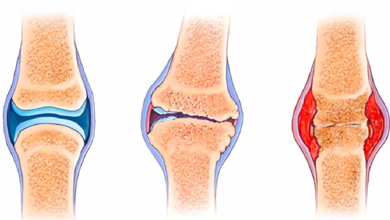 खराब लाइफ स्टाइल, जंक फूड.... बढ़ा रहा ऑस्टियोआर्थराइटिस और रूमेटॉइड आर्थराइटिस के मरीज