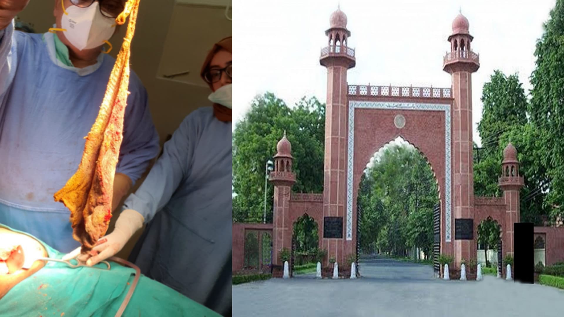 Aligarh News: पेट में छोड़े सर्जिकल स्पंज, AMU मेडिकल कॉलेज के डॉक्टर ने निकाला बाहर