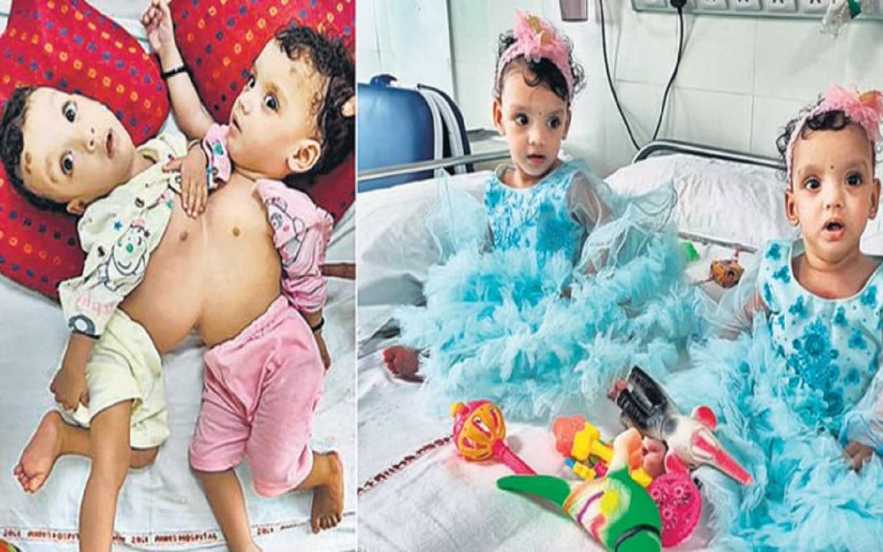 एम्स के डॉक्टरों ने रचा इतिहास, 12 घंटे की सर्जरी के बाद छाती और पेट से जुड़ी जुड़वां बच्चियों को किया अलग