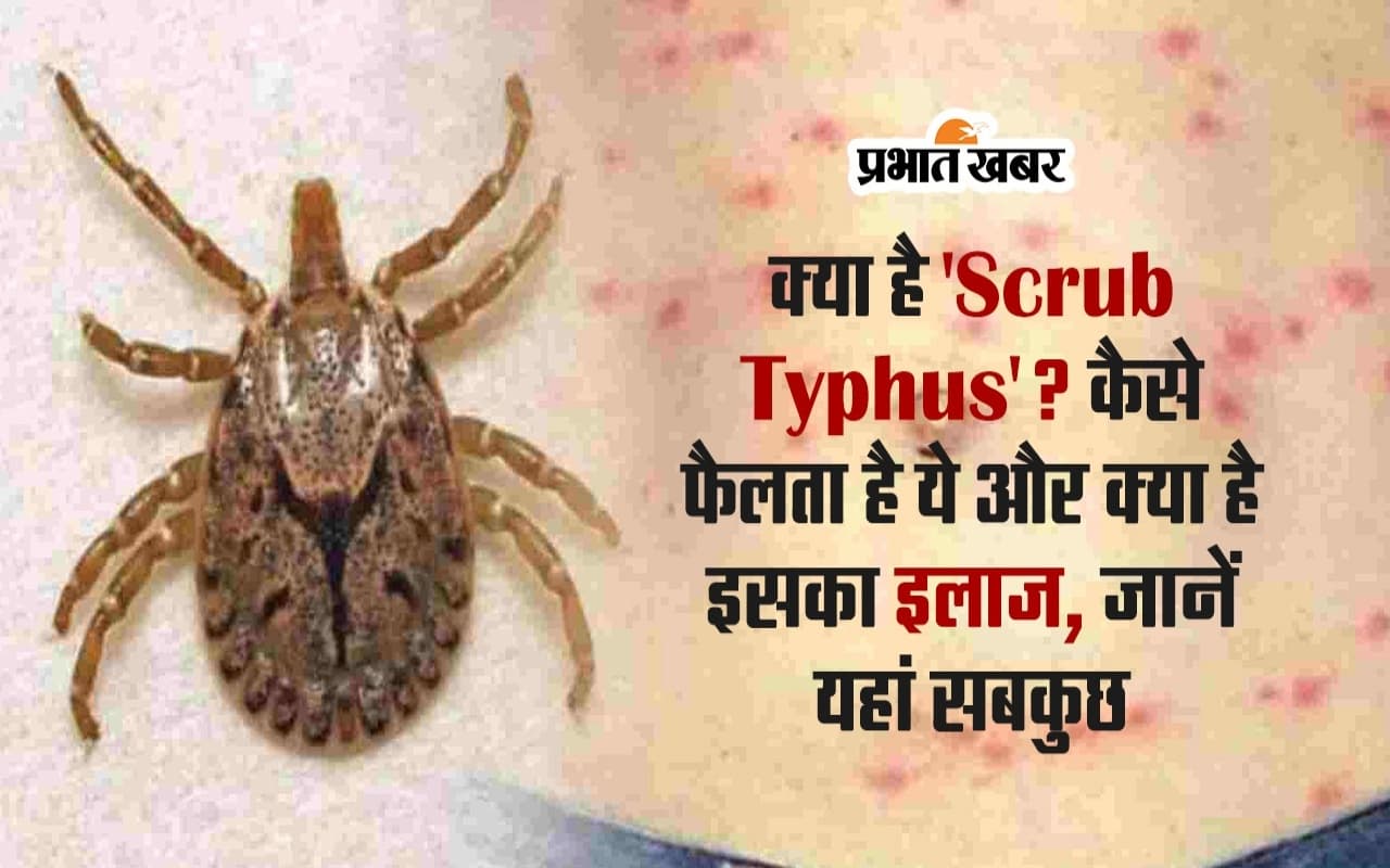 VIDEO: क्या है 'Scrub Typhus'? कैसे फैलता है ये और क्या है इसका इलाज