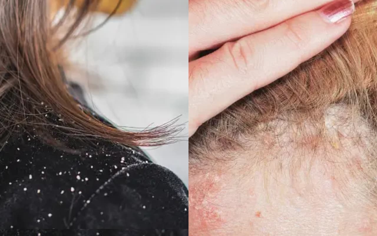 कैसे समझे डैंड्रफ है या स्कैल्प सोरायसिस ? जानिए दोनों का अंतर कैसे समझे डैंड्रफ है या स्कैल्प सोरायसिस ? जानिए दोनों का अंतर