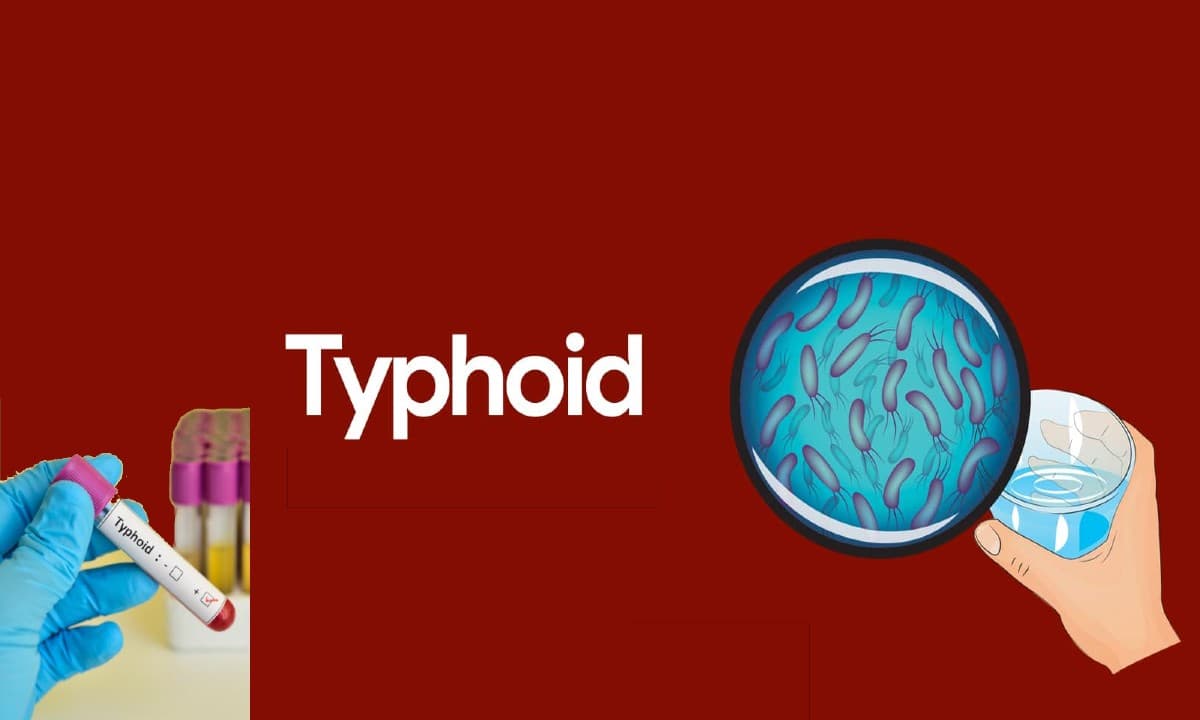 Typhoid Fever: टाइफाइड बुखार हुआ और घातक, एंटीबायोटिक के खिलाफ प्रतिरोधी हुए बैक्टीरिया