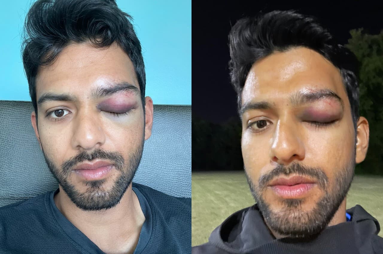 टीम इंडिया के अंडर-19 स्टार उन्मुक्त चंद के आंख पर लगी चोट, सोशल मीडिया पर शेयर की तस्वीर
