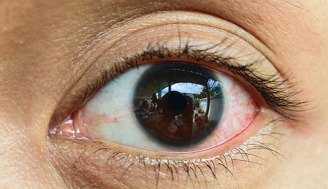 कोविड-19 से स्वस्थ होनवाले 50% मरीजों में म्यूकोर्माइकोसिस के लक्षण, संक्रमण की संभावना कम करने के लिए नियंत्रण में रखें डायबिटीज