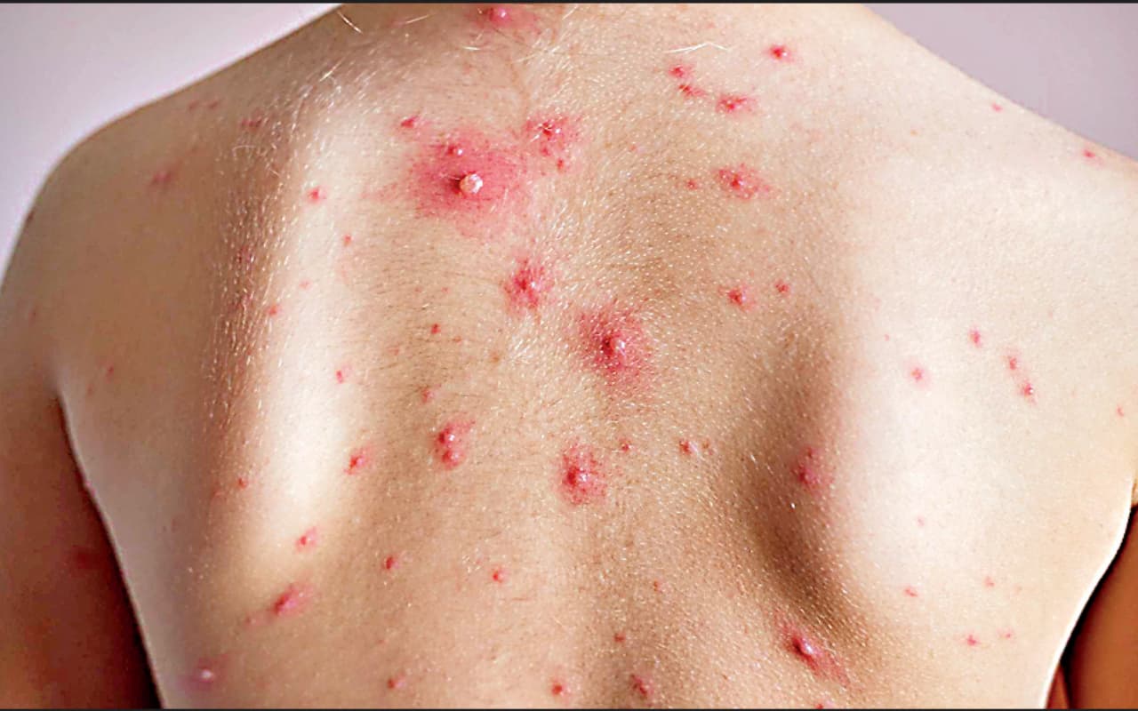 रांची में चिकन पॉक्स व खसरा की चपेट में आ रहे बच्चे, डॉक्टरों ने सावधान रहने की दी सलाह