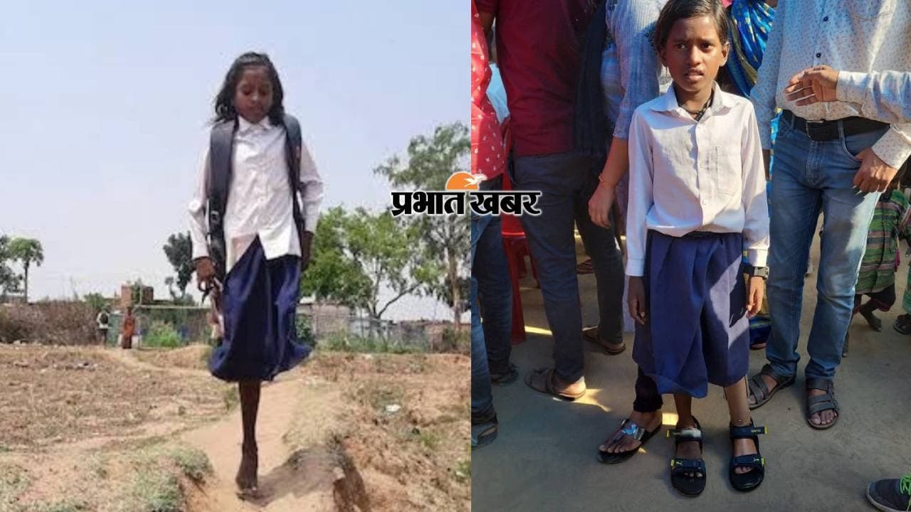 अब दोनों पैरों पर चलकर स्कूल जाएगी जमुई की सीमा, सरकार ने लगवाया कृत्रिम पैर