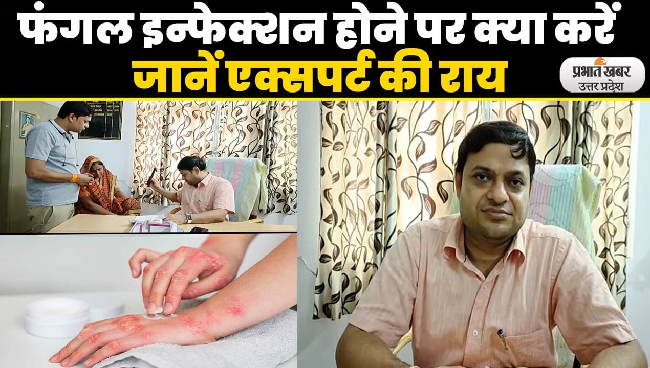 Skin Disease Treatment: मौसम में भीषण उमस, फंगल इन्फेक्शन के मरीजों में इजाफा