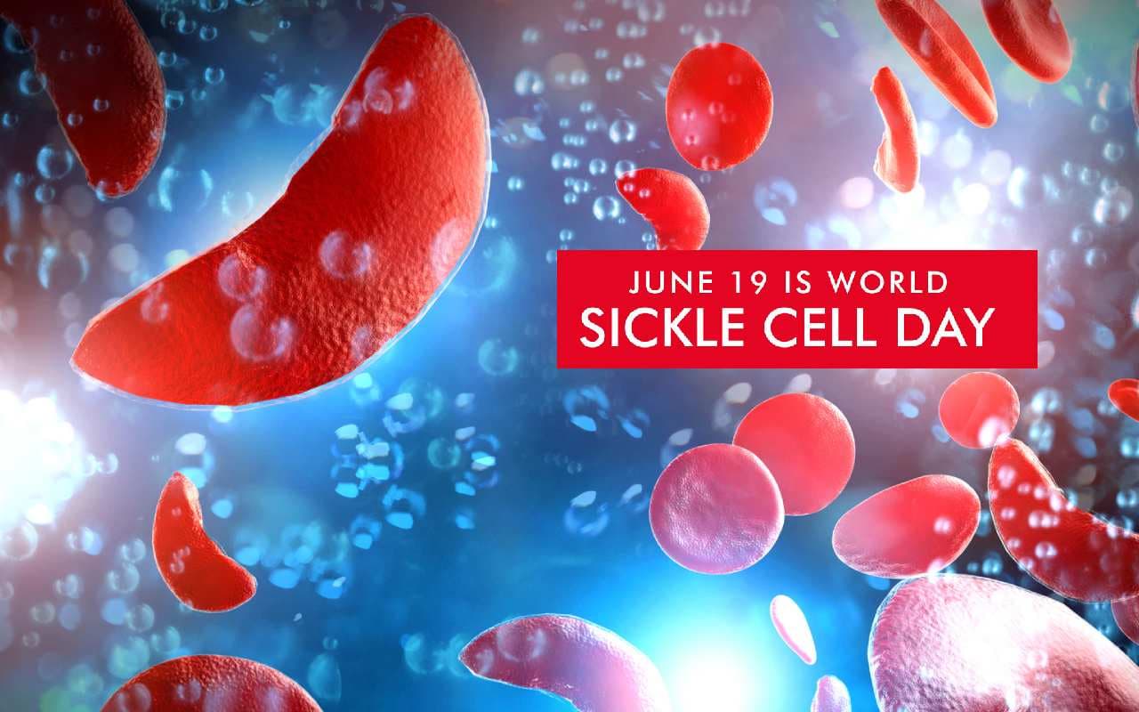 World Sickle Cell Day 2023: वर्ल्ड सिकल सेल अवेयरनेस डे आज,  जानें इसके लक्षण और कारण