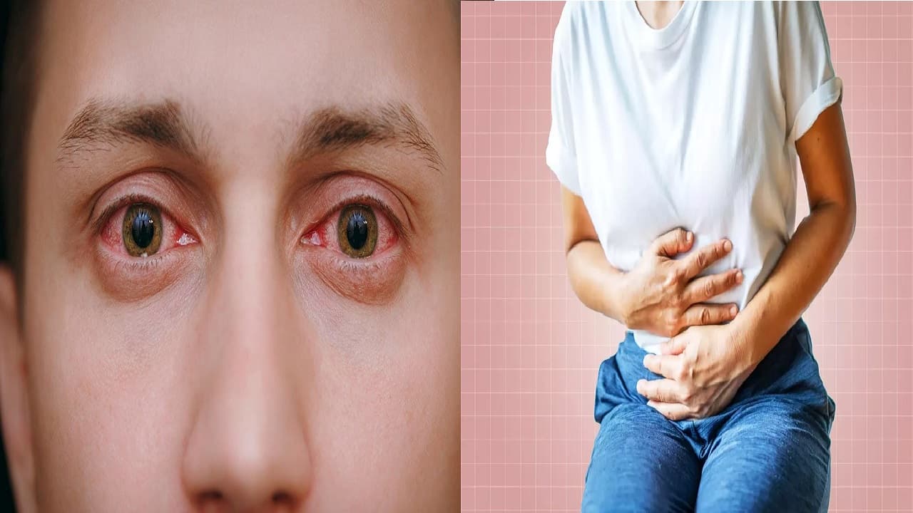 Explainer: बदलते मौसम में बढ़ी मरीजों की संख्या, आई फ्लू के बाद डायरिया का प्रकोप, जानें क्या है बचने के उपाय