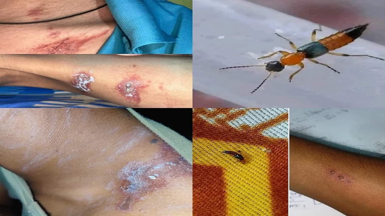 Bihar: अफ्रीका की जहरीली मक्खी Acid Fly पहुंची बिहार, शरीर पर बैठकर अंधेपन का बनाती है शिकार, मचा हड़कंप