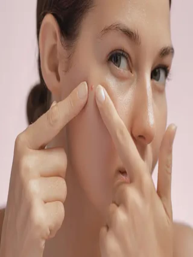 BEAUTY TIPS : चेहरे से मुंहासों को करें छूमंतर, आजमाएं ये उपाय