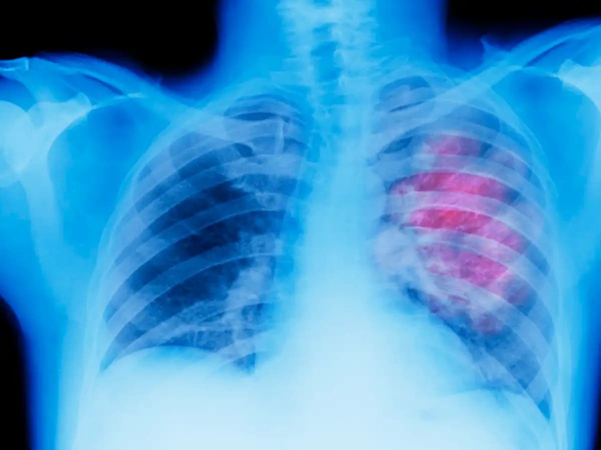 AI for Health: सीने के एक्स-रे से उम्र बताने वाला एआई-मॉडल विकसित, इन बीमारियों का पता लगाने में होगा मददगार