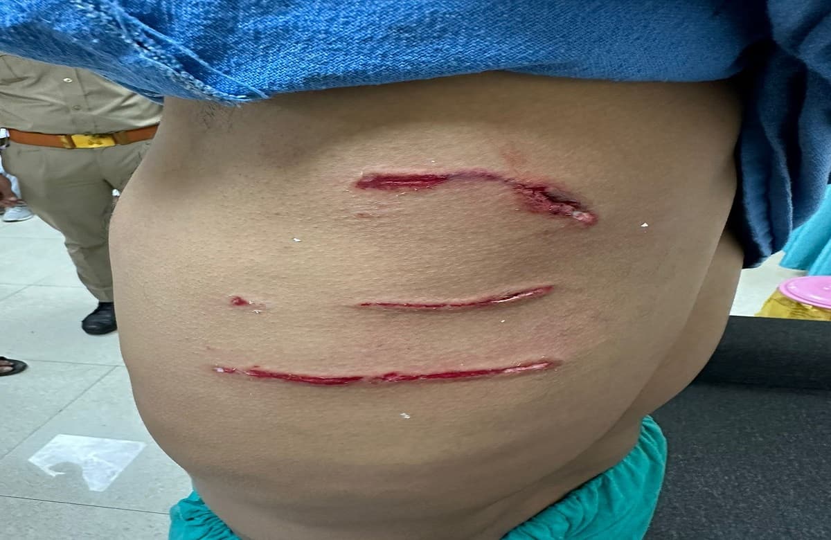 अलीगढ़: एएमयू में अब पीएचडी स्कॉलर पर आवारा कुत्तों ने किया हमला, घायल छात्र सदमें में