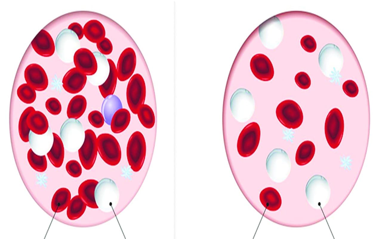 धनबाद में महिलाएं तेजी से हो रही एनीमिया की शिकार, ऐसे करें बचाव